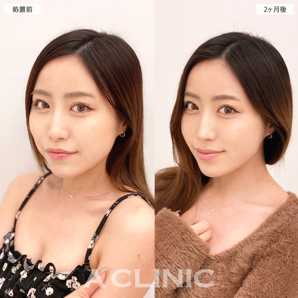 1day小顔脂肪吸引でフェイスラインが整い綺麗なEラインになりました！こちら処置前と2ヶ月後の症例です(30代女性)