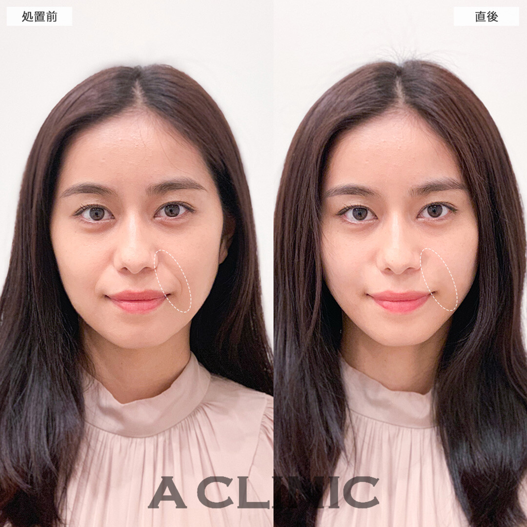 Aスレッドでほうれい線が薄くなります！処置前と直後の症例です(20代女性)