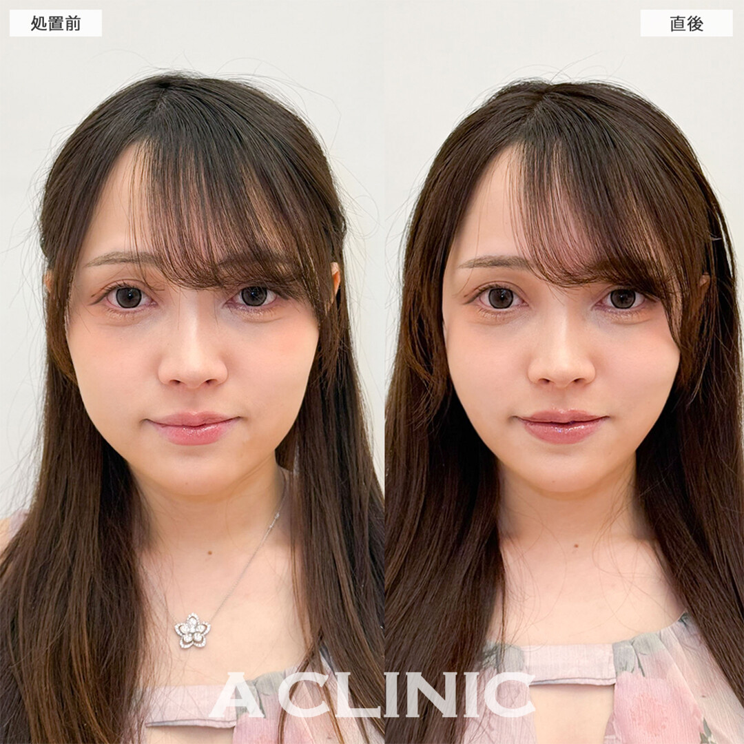 Aスレッドは周りにバレずに小顔になれます！こちら処置前と直後の症例です(20代女性)