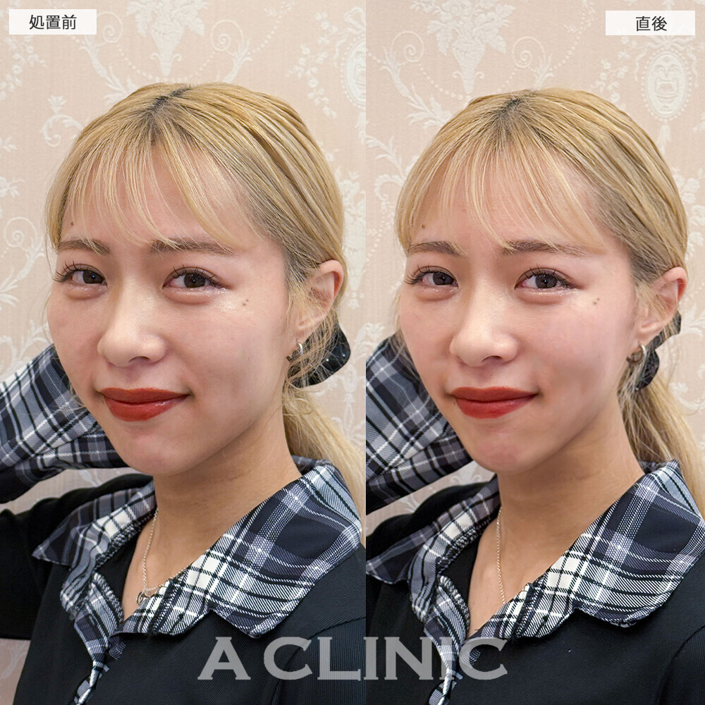 Aスレッドでフェイスラインの左右差を整えます！こちら処置前と直後の症例です(20代女性)