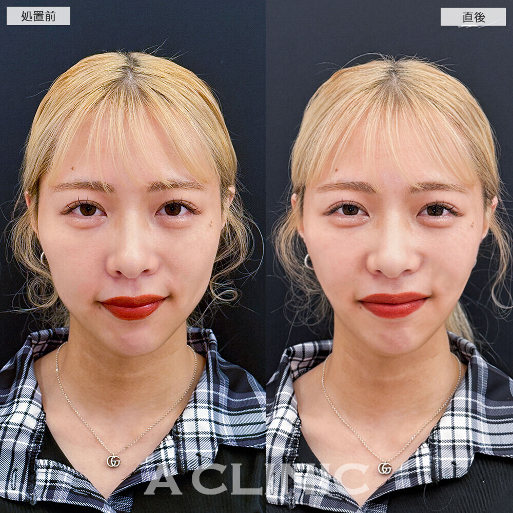Aスレッドでフェイスラインの左右差を整えます！こちら処置前と直後の症例です(20代女性)