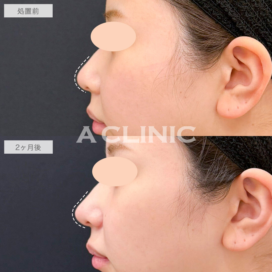 鼻尖形成(耳介軟骨・耳珠軟骨移植)で自然にツンとした鼻先に！処置前と2ヶ月後の症例です(20代女性)
