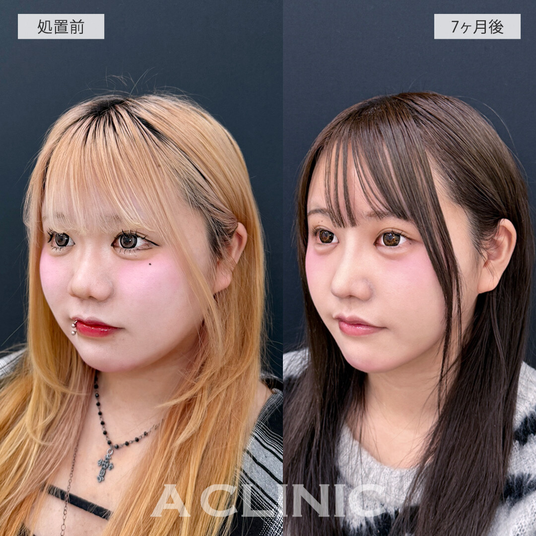 1day小顔脂肪吸引で別人級の小顔に大変身！処置前と7ヶ月後の症例です(10代女性)
