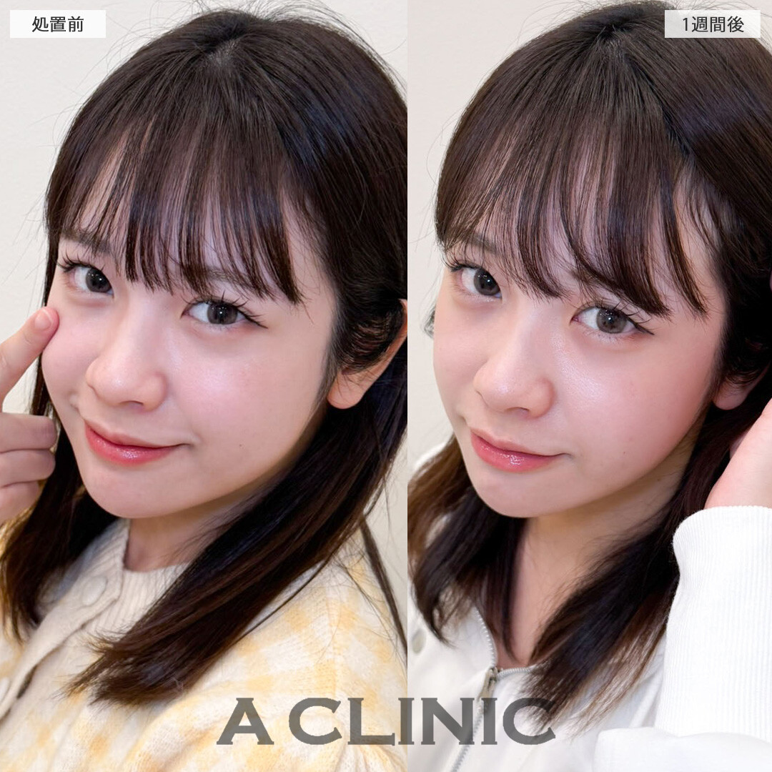 パーフェクトアイズで加工必須だった目元が自然に大きく優しい印象になりました！こちら処置前と１週間後の症例です(20代女性)