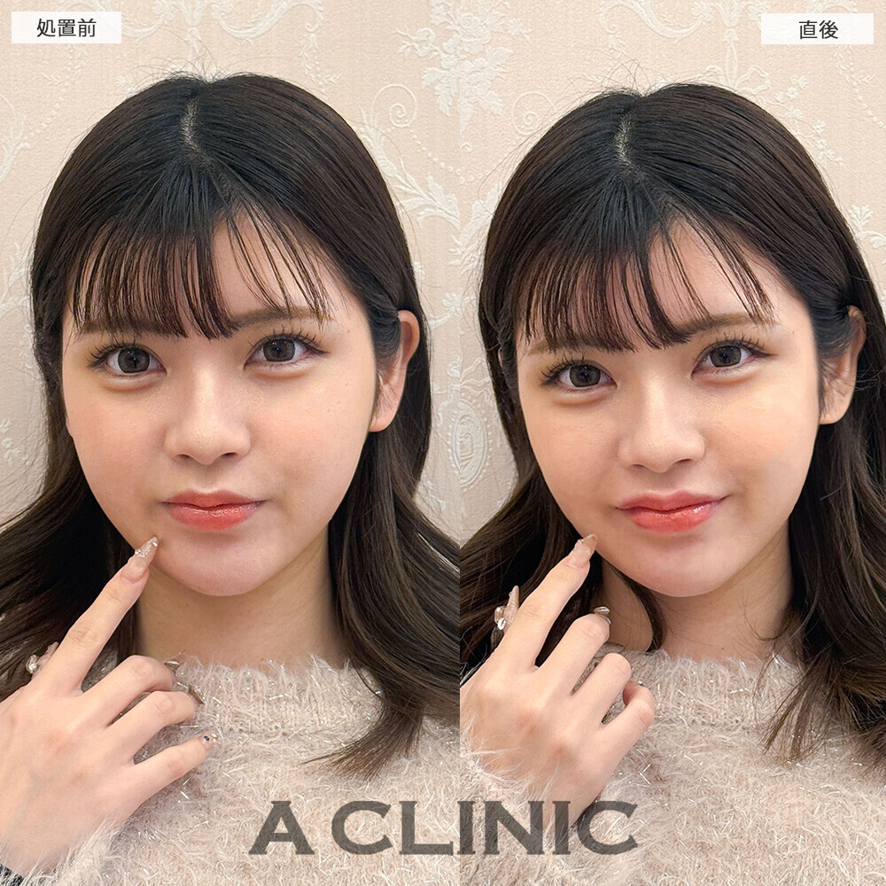 スマイルリップで存在感のある可愛い唇に！こちら処置前と直後の症例です(20代女性)
